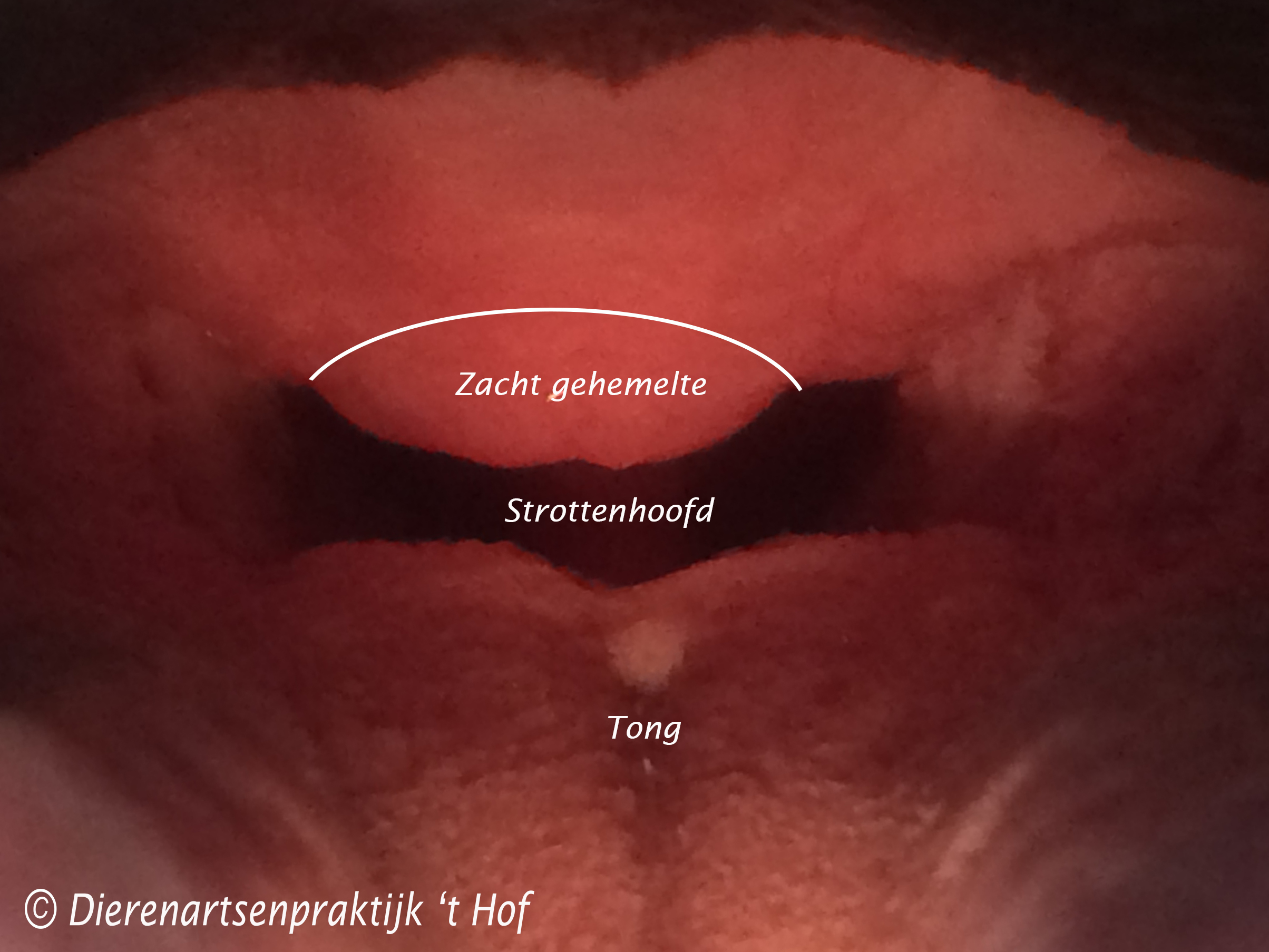 Het te lange zachte gehemelte valt als een gordijn voor het strottenhoofd